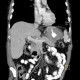 Metastases of malignant melanoma, liver, stomach, adrenal gland, retroperitoneal lymph nodes: CT - Computed tomography